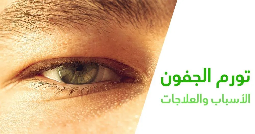 تورم الجفون الأسباب والعلاجات